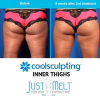 CoolSculpting for Inner Thighs in NYC