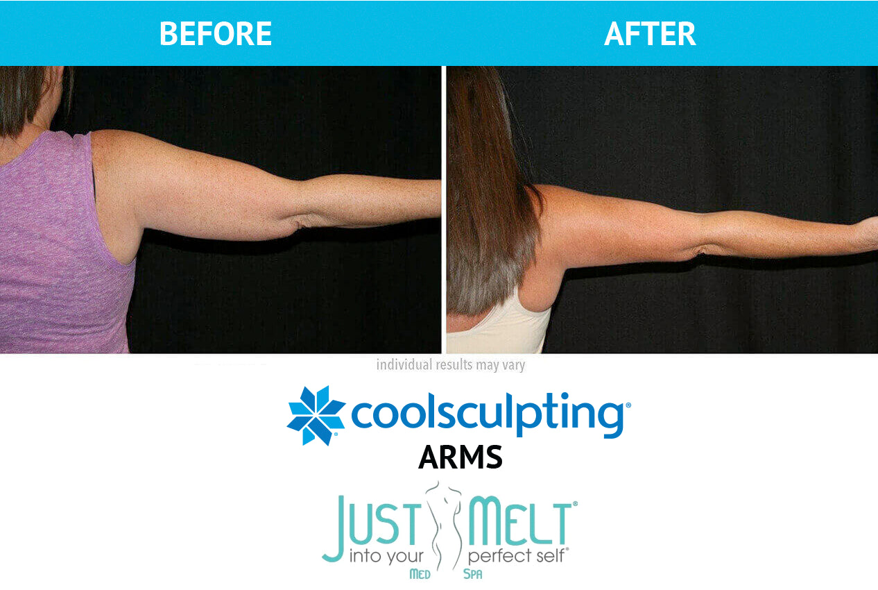 CoolSculpting for Arms, Upper Arm CoolSculpting Treatment NYC - Dr