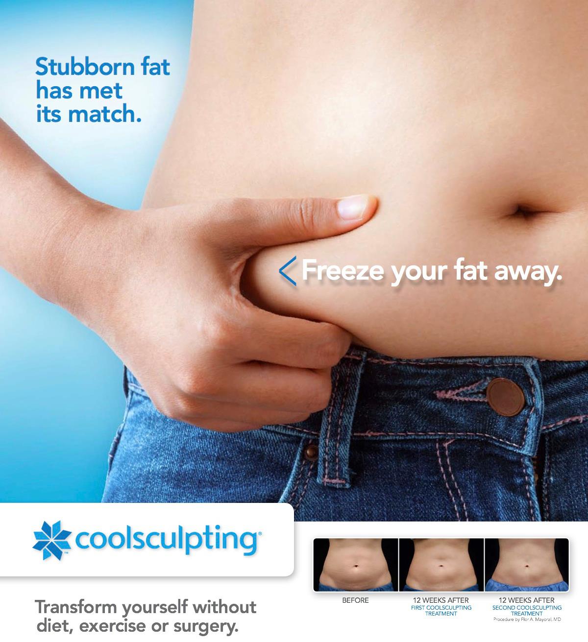 Two CoolSculpting® sessions on the flanks helped this patient achieve his  goals of reducing stubborn fat on his love handles. Individual…