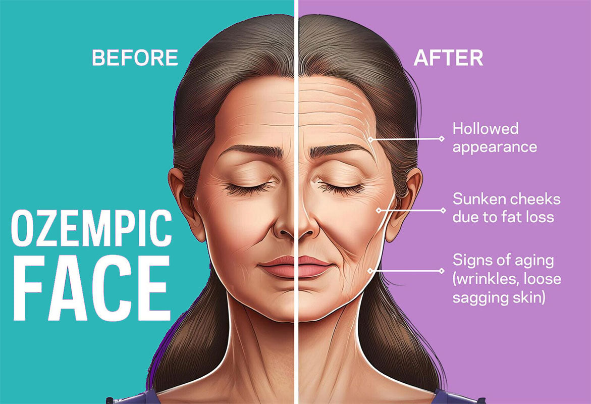 Ozempic Face Treatment in NYC