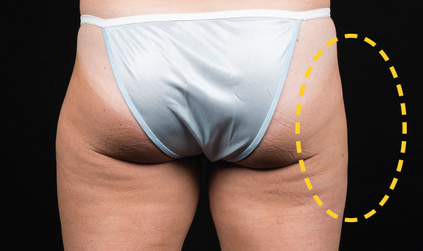 Melt Away Your Thigh Fat With CoolSculpting